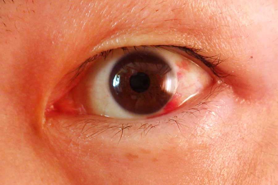 結膜下出血。目の血管が破れることで白目が赤く染まる（写真はイメージ）【写真：写真AC】