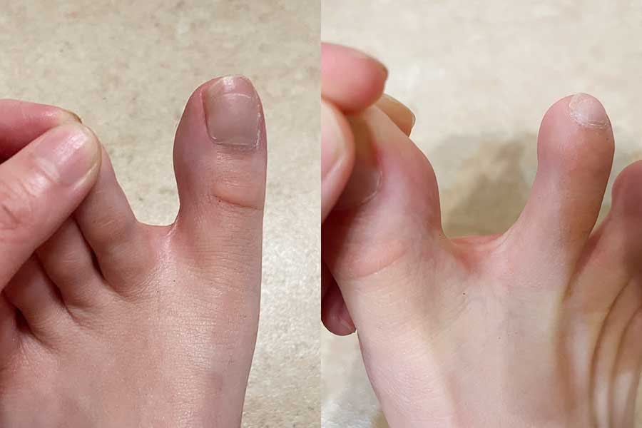 検証後の両足。（左から）裏ワザの左足の指の間と、何もしていない右足の指の間。どちらも摩擦で赤くなったが、右足は広範囲が赤い【写真：Hint-Pot編集部】