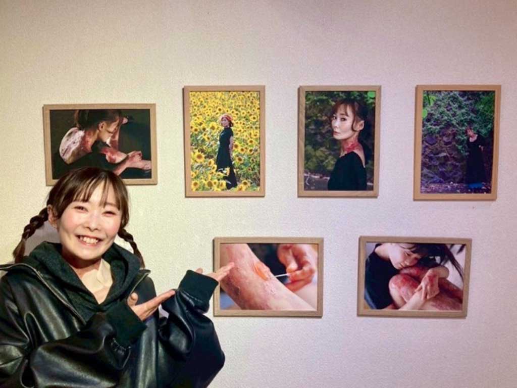 表皮水疱症を伝えるために写真展を開いたことも【写真：梅津真里奈（@marina19951231）さん】
