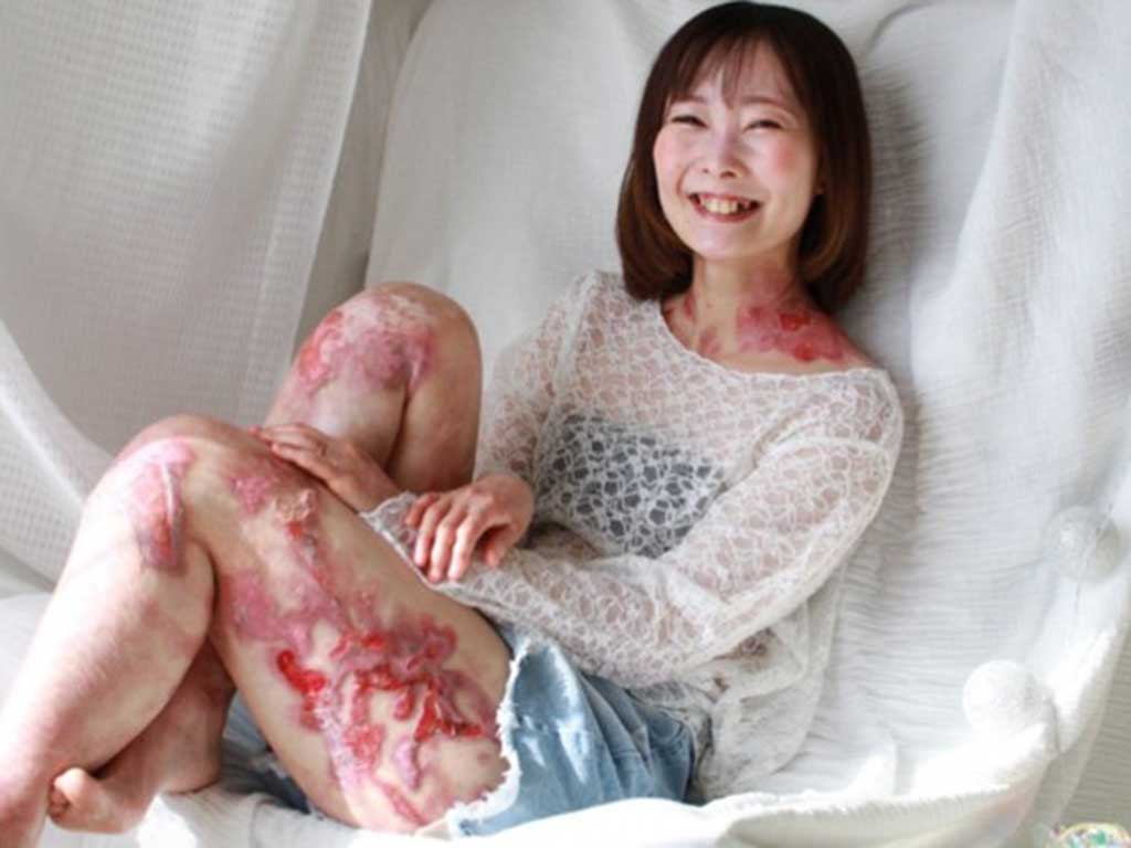 表皮水疱症の患者は“蝶の羽”に例えられるほど皮膚が弱い【写真提供：梅津真里奈（@marina19951231）さん】