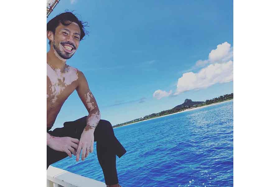 2019年頃。白斑は広範囲に広がってきた【写真提供：クニハルさん（vitiligo.9286）】