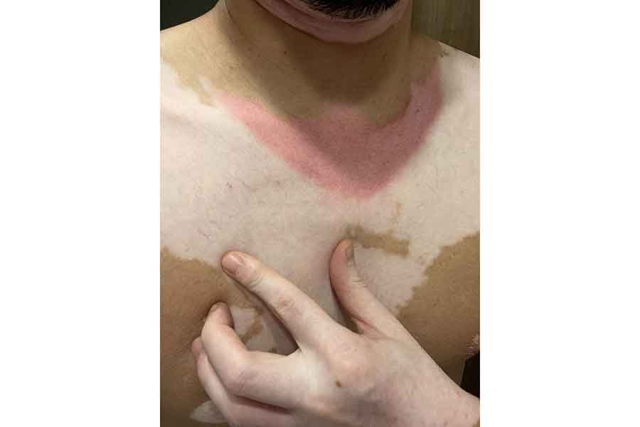 白斑が日焼けしたとき【写真提供：クニハルさん（vitiligo.9286）】