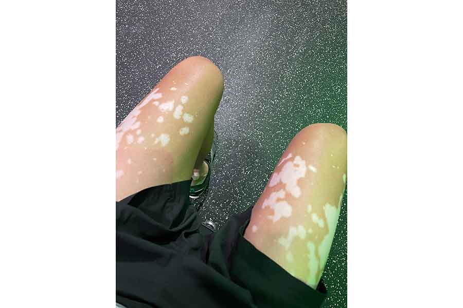 「猫の肉球みたい」と言われてうれしかった太ももの白斑【写真提供：クニハルさん（vitiligo.9286）】