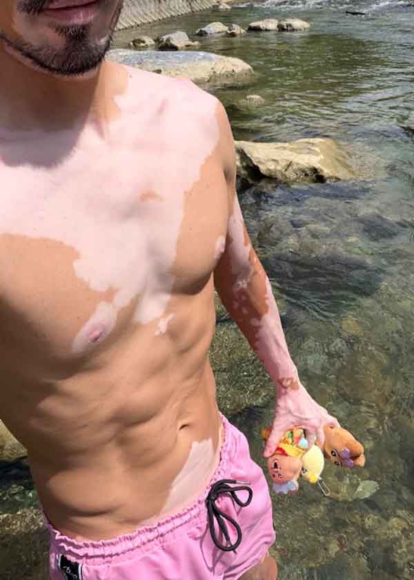 SNSでありのままの姿を発信している【写真提供：クニハルさん（vitiligo.9286）】