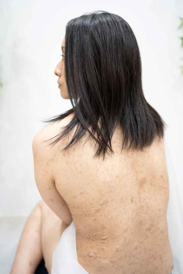 背中の神経線維腫は400個以上切除してきた【写真提供：大河内愛美（＠manamiokochi）さん】