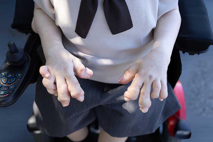 現在の手の状態【写真提供：奈須香織（nasukaori_hyaline）さん】